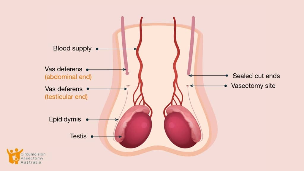 Men Vasectomy